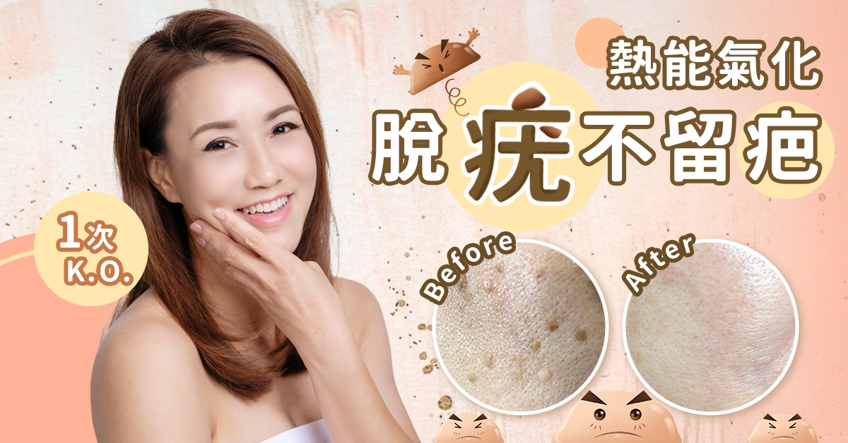 GB0032109A04_Gosip_google_banner_脫疣B-G1